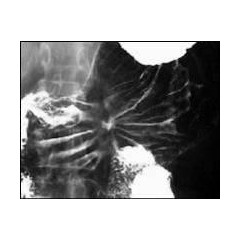 На рентгене видно язву желудка