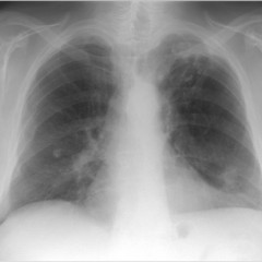 Рентгенограмма органов грудной клетки при бронхите thumbnail