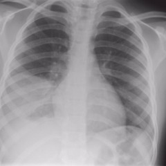 Рентген снимок легких при пневмонии у ребенка