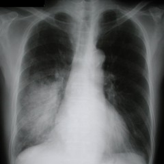 После пневмонии изменения на рентгенограмме