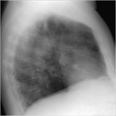 Рентген грудной клетки при хроническом бронхите thumbnail