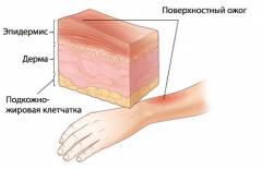 как определить площадь поражения при ожогах