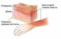 как определить площадь поражения при ожогах