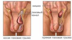 Хирургическая анатомия паховой грыжи