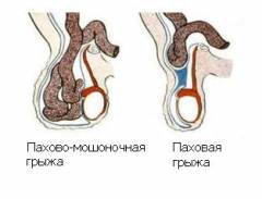 У меня паховая грыжа уже 2 года