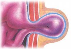 Вид пупка после грыжи