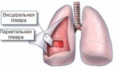 polismed.com, плеврит., причины,, симптомы,, признаки,, диагностика, и, лечение, патологии