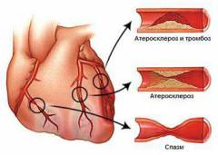 polismed.com, кардиосклероз., причины,, симптомы,, признаки,, диагностика, и, лечение, патологии