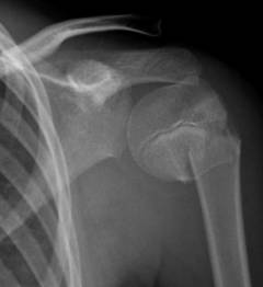 В каком месте плечевой кости переломы возникают чаще всего