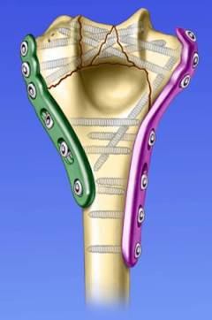 Какой нерв повреждается при переломе плечевой кости