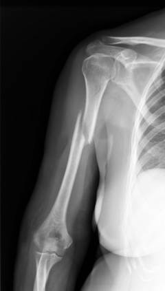 Перелом костей плеча в типичном месте
