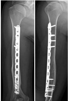 Переломы костей плеча классификация диагностика лечение