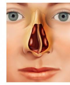 При переломе перегородки носа