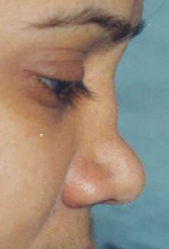 Ушиб носа причины, симптомы, методы лечения и профилактики