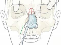 Основной симптом перелома костей носа