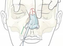 Лечение перелом костей носа