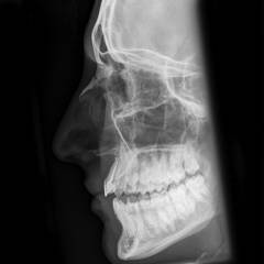 Виды переломов костей носа