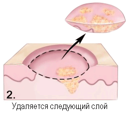 Биопсия при меланоме