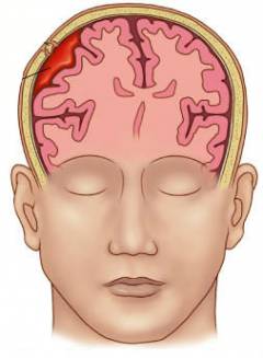 Симптомы и лечение водянки головного мозга у детей и взрослых