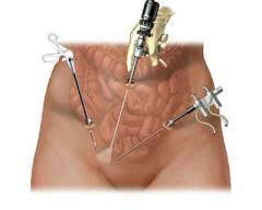 Диагностическая лапароскопии кисты яичника