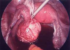 Показания для лапароскопии кисты яичника