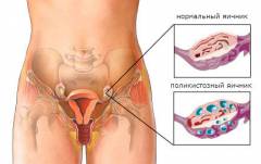 Показания для лапароскопии кисты яичника
