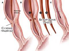 Спазм пищевода желудка при язве