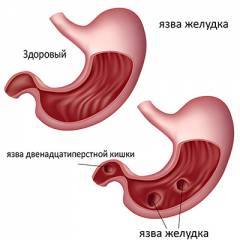 Легочное сердце что это такое симптомы и признаки. Смотреть фото Легочное сердце что это такое симптомы и признаки. Смотреть картинку Легочное сердце что это такое симптомы и признаки. Картинка про Легочное сердце что это такое симптомы и признаки. Фото Легочное сердце что это такое симптомы и признаки