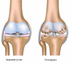 краевые остеофиты суставных поверхностей что это. Смотреть фото краевые остеофиты суставных поверхностей что это. Смотреть картинку краевые остеофиты суставных поверхностей что это. Картинка про краевые остеофиты суставных поверхностей что это. Фото краевые остеофиты суставных поверхностей что это
