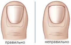 Воспаление ногтевого ложа после удаления ногтя