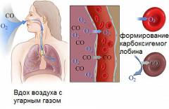 Отравление угарным газам рвота