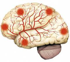 Аневризма головного мозга последствия после операции