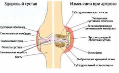 polismed.com, артроз, стопы, (голеностопного, сустава)., причины,, симптомы,, диагностика, и, лечение, артроза