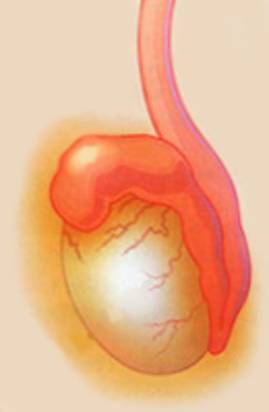 Придаток яичка у мужчин лечение