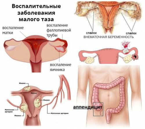 После Секса Стал Болеть Низ Живота