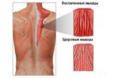 Миалгия что это симптомы и причины. Смотреть фото Миалгия что это симптомы и причины. Смотреть картинку Миалгия что это симптомы и причины. Картинка про Миалгия что это симптомы и причины. Фото Миалгия что это симптомы и причины