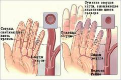 Болезнь рейно чем лечат. sm 847789001506364337. Болезнь рейно чем лечат фото. Болезнь рейно чем лечат-sm 847789001506364337. картинка Болезнь рейно чем лечат. картинка sm 847789001506364337.