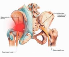Изображение - Боль в ягодичном суставе sm_451418001450614335