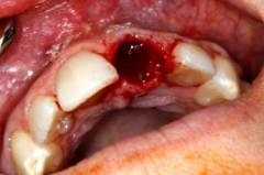 болит рот после удаления зуба