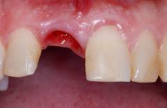 После удаления болят нижние зубы