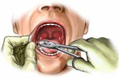 как долго болят зубы после удаления зуба