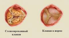 polismed.com, аортальный, стеноз, 