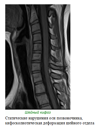 Статические нарушения позвоночника. Кифоз с5-с6 шейного отдела. Дорзальная протрузия с5/6 диска шейного отдела позвоночника. Дорзальная протрузия с6/7 диска шейного отдела. Кифоз шейного отдела с4 с5 с6.