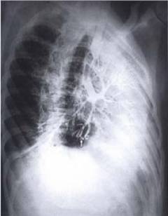 Бронхография при бронхиальной астме thumbnail
