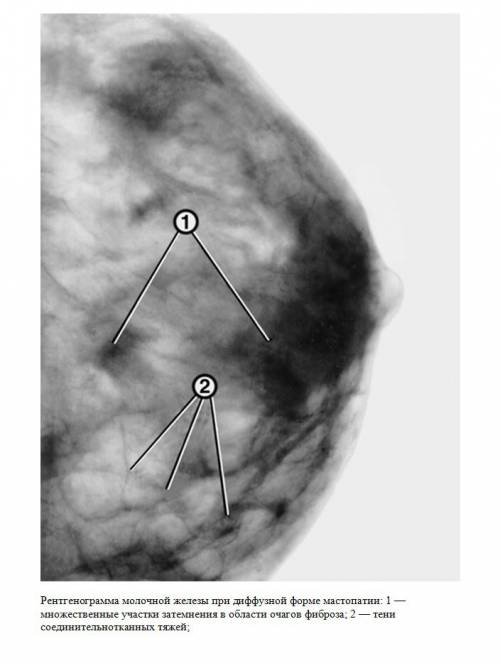 Двухсторонняя диффузная. Диффузная кистозная мастопатия. Фиброзно кистозная мастопатия маммограмма. Фиброзная мастопатия молочной железы что это.