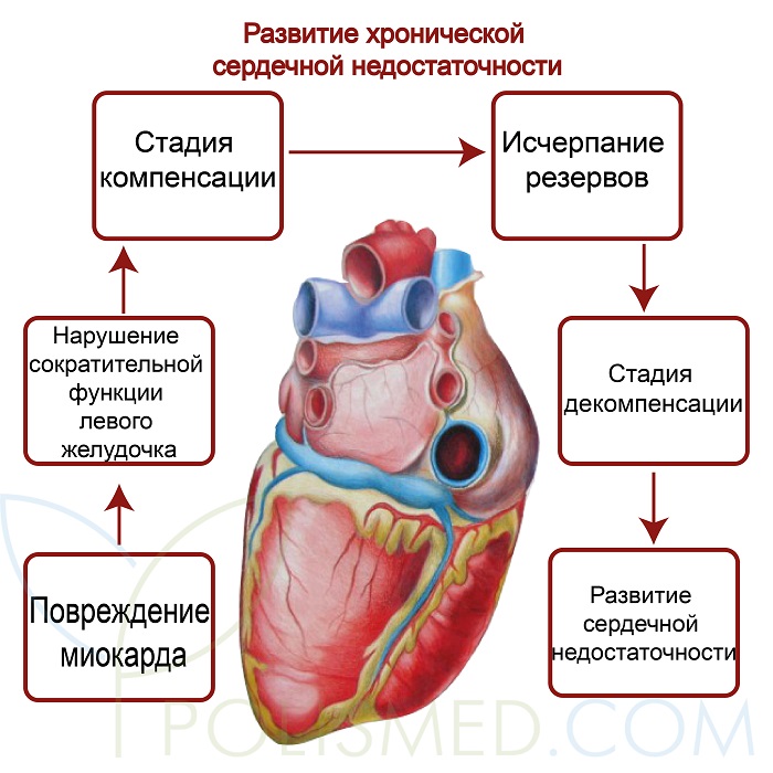 Сильная сердечная недостаточность