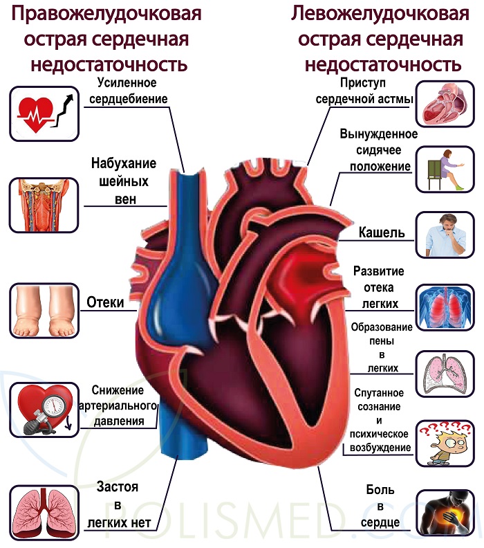Симптомы острой сердечной недостаточности