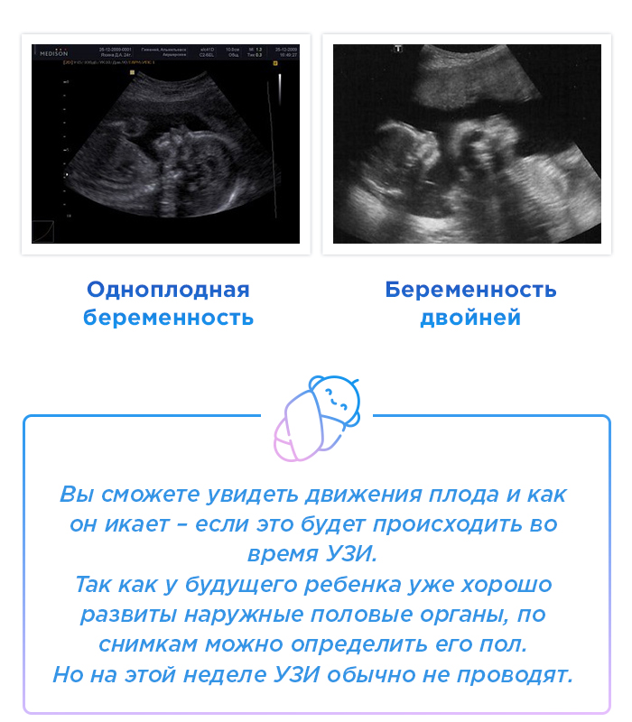 Размер плода в 20 недель. Многоплодная беременность 25 недель УЗИ. УЗИ ребенка по неделям беременности.