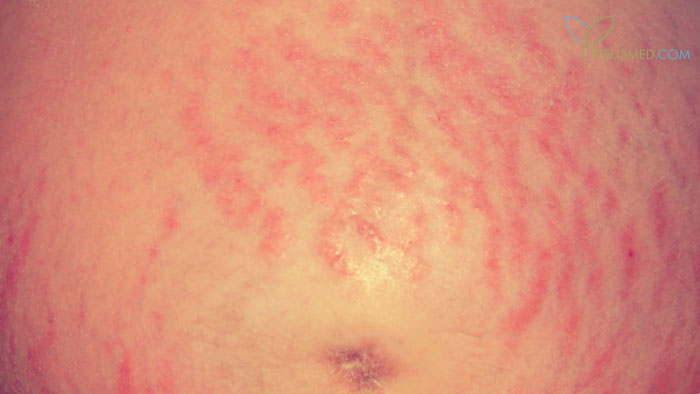 Зудящая красная сыпь на животе