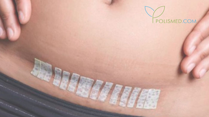 кесарево сечение